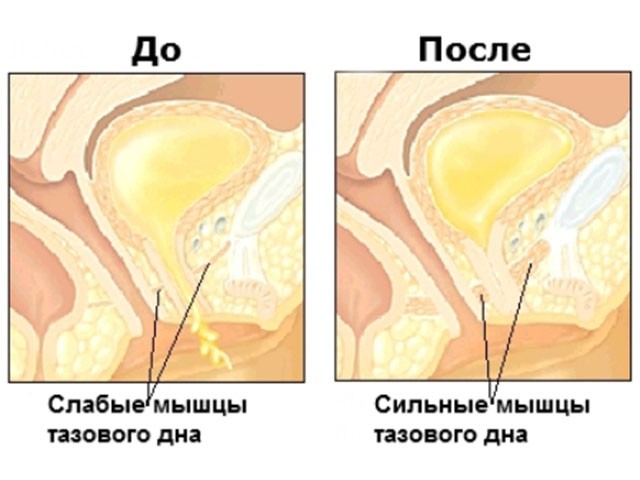  тренировки мышц тазового дна